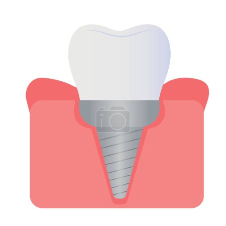 Implanted tooth in gum on white background