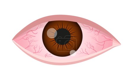 Illustration for Dry eye syndrome. Inflamed bloodshot eyeball with swelling, irritation and red conjunctiva. Symptoms of infection, allergy, keratitis, blepharitis, conjunctivitis, uveitis. Vector cartoon illustration - Royalty Free Image