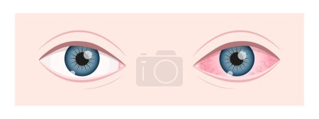 Illustration for Healthy and ill human vision organ. Dry eye syndrom. Inflamed eyeball with irritation and red conjunctiva. Symptoms of keratitis, blepharitis, conjunctivitis or uveitis. Vector flat illustration. - Royalty Free Image