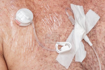 Tube avec soupape et raccord articulaire pour injections de fluides intraveineux sur orifice implantable pour chimiothérapie

