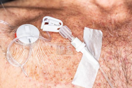 Téléchargez les photos : Tube avec soupape et raccord articulaire pour injections de fluides intraveineux sur orifice implantable pour chimiothérapie - en image libre de droit