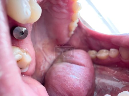 Téléchargez les photos : Open mouth at the doctor with titanium dental implant - en image libre de droit