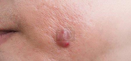 Foto de Bacterial skin infection. Big Acne Cyst Abscess or Ulcer Swollen area within face skin tissue. Containing accumulation of pus and blood. Macro shot of Acne or Dermatitis near mouth on face. Skincare. - Imagen libre de derechos