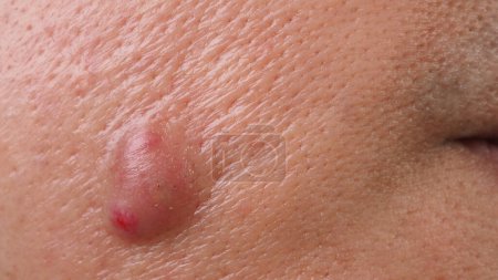 Foto de Bacterial skin infection. Big Acne Cyst Abscess or Ulcer Swollen area within face skin tissue. Containing accumulation of pus and blood. Macro shot of Acne or Dermatitis near mouth on face. Skincare. - Imagen libre de derechos