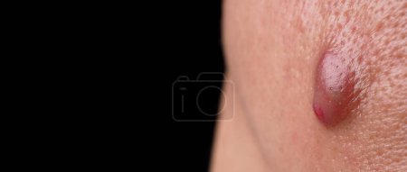 Photo for Bacterial skin infection. Big Acne Cyst Abscess or Ulcer Swollen area within face skin tissue. Containing accumulation of pus and blood. Macro shot of Acne or Dermatitis near mouth on face. Skincare. - Royalty Free Image