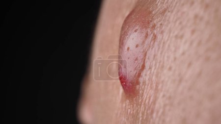 Téléchargez les photos : Bacterial skin infection. Big Acne Cyst Abscess or Ulcer Swollen area within face skin tissue. Containing accumulation of pus and blood. Macro shot of Acne or Dermatitis near mouth on face. Skincare. - en image libre de droit