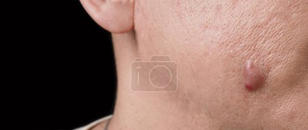Photo for Bacterial skin infection. Big Acne Cyst Abscess or Ulcer Swollen area within face skin tissue. Containing accumulation of pus and blood. Macro shot of Acne or Dermatitis near mouth on face. Skincare. - Royalty Free Image