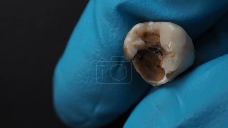 Foto de Tooth decay and dentist hand with glove and black background. Macro shot of a decayed teeth till root after extraction of dentist. Real tooth anatomy due lack of dental care. Top view of caries teeth - Imagen libre de derechos