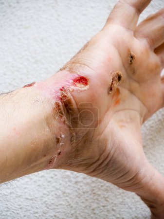 Téléchargez les photos : Electric shock entry and exit wounds and burns in 50s adult caucasian man hand wrist healing and skin peeling after medical treatment. - en image libre de droit