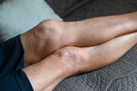 Seniorin Bein mit Krankheit, Ostheo-Arthritis-Entzündung geschwollene Gelenke und Gliedmaßen hoch res Foto