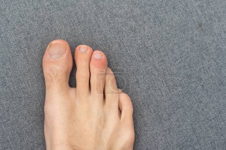 Foto de Hombre dedos de los pies con el pelo y las uñas sucias - Imagen libre de derechos