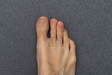 Foto de Joven pie peludo masculino blanco con uñas de los pies descuidadas. - Imagen libre de derechos