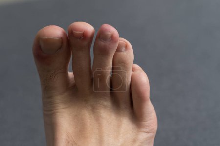 Téléchargez les photos : The foot, five toes, of a caucasian male with a damaged toe. Underneath the nail. small round cancerous spot. The small pimple like sore is melanin cancer - en image libre de droit