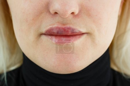 woman asymmetric lips as a result after lip augmentation with hyaluronic acid filler entered incorrectly, bad result, cosmetologists mistake, contour lip plastic surgery.