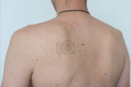 Téléchargez les photos : Corps masculin avec vitiligo. Taches blanches sur la peau. Du vitiligo. Photo de haute qualité - en image libre de droit