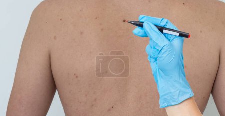 Foto de Vista recortada del dermatólogo examinando la piel del paciente con lupa en la clínica. Foto de alta calidad - Imagen libre de derechos