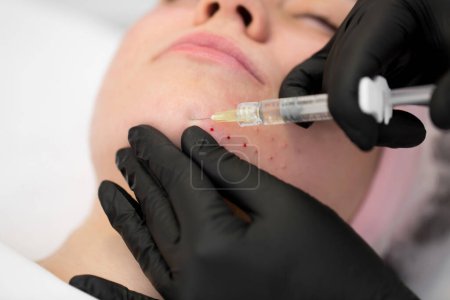 Foto de El primer plano del cosmetólogo hace el procedimiento de inyecciones faciales rejuvenecedoras para apretar la piel de la cara de la mujer en una clínica de belleza. Procedimiento de biorevitalización - Imagen libre de derechos