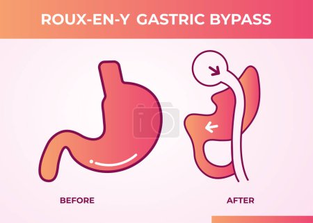 Téléchargez les illustrations : Roux-en-Y Gastric Bypass (RNY) Perte de poids Chirurgie icône vectorielle illustration - en licence libre de droit