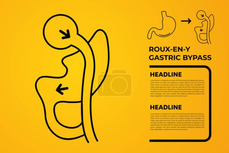 Téléchargez les illustrations : Roux-en-Y Gastric Bypass (RNY) Perte de poids Chirurgie icône vectorielle illustration - en licence libre de droit