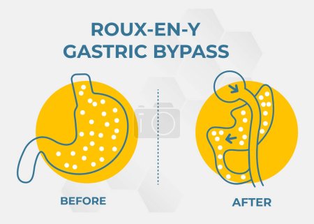 Illustration for Roux-en-Y Gastric Bypass (RNY) Weight Loss Surgery vector illustration icon - Royalty Free Image