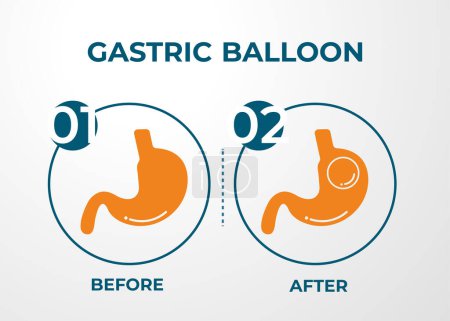 Illustration for Stomach Endoscopy Gastric Balloon Inside a Stomach weight loss surgery vector illustration obesity - Royalty Free Image
