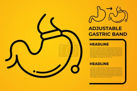 Illustration for Illustration of Adjustable Gastric Band devise Weight Loss Surgery vector - Royalty Free Image