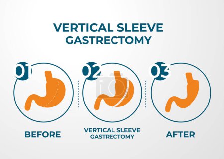 Gastrectomía de manga laparoscópica, Gastrectomía vertical, Cirugía de pérdida de peso Vector Ilustración de la cirugía de reducción de estómago