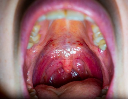 Entzündete Kehle einer kranken Person, rote Blutgefäße der oberen Wand der Mundhöhle