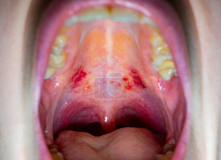 Garganta inflamada de una persona enferma, vasos sanguíneos rojos de la pared superior de la cavidad oral