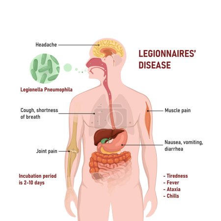 Illustration for Legionnaires disease or legionellosis or Legion fever. Signs and symptoms is a form of atypical pneumonia. - Royalty Free Image