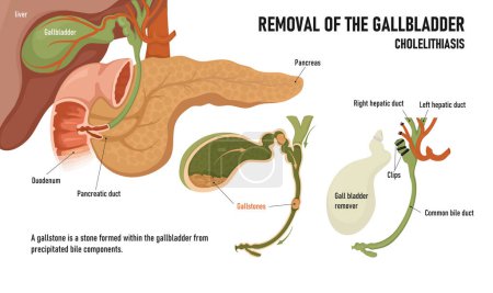 Illustration for Cholecystitis. Inflammation of the gallbladder and bile ducts. Gallstones. Removal of the gallbladder - Royalty Free Image