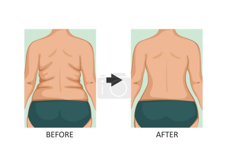 Illustration for Back Lift. Back before and after diet, fitness or liposuction - Royalty Free Image