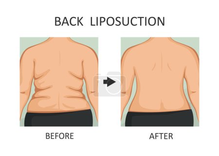 Back Lift. Back before and after diet, fitness or liposuction