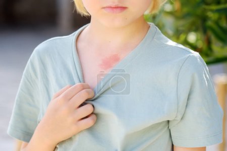 Photo for Mark on the skin of chest of eight years old child. Hemangioma is a red birthmark from blood vessels on the skin, benign tumor. Medicine and health care - Royalty Free Image