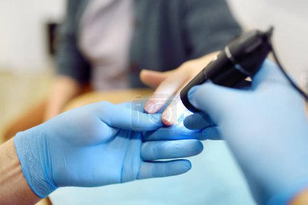 Foto de cerca de la mano del paciente durante una cita con un reumatólogo. El médico examina el lecho de las uñas y los vasos sanguíneos de los dedos de una joven a través de un microscopio. Diagnóstico reumatológico