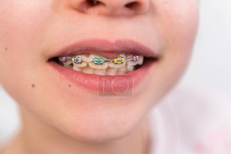 Foto de Primer plano de la boca de una chica con frenos de arco iris. - Imagen libre de derechos