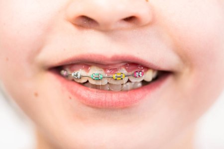 Photo for Close-up of the mouth of a girl with rainbow braces. - Royalty Free Image