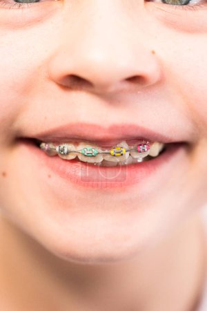 Téléchargez les photos : Gros plan sur la bouche d'une fille avec des accolades arc-en-ciel. - en image libre de droit