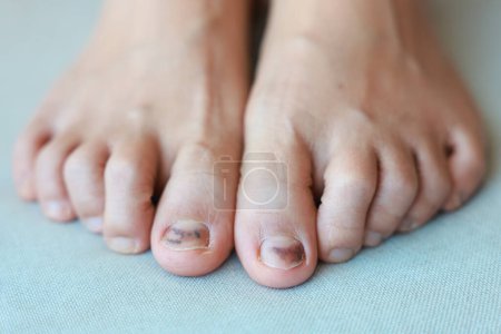 Hématome subungual sur l'ongle du pied sont des blessures de porter des chaussures qui sont trop serrés dans lequel saignement se développe sous l'ongle. Blessure par écrasement de l'ongle ou de l'ongle du pied de la phalange distale, ongle du pied noir.