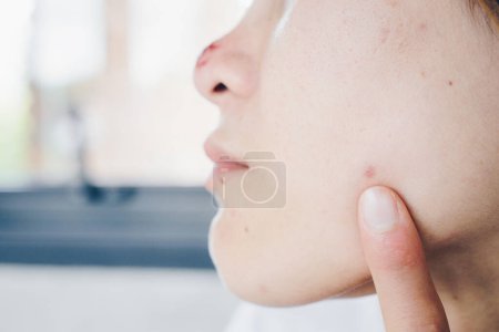 Téléchargez les photos : Femme asiatique pointant vers l'acné se produisent sur sa peau. - en image libre de droit