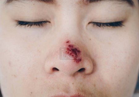 Téléchargez les photos : Le Herpes simplex sur le nez de la femme asiatique, Herpes simplex est une maladie virale causée par le virus de l'herpès simplex. Les infections sont classées en fonction de la partie du corps infectée.. - en image libre de droit
