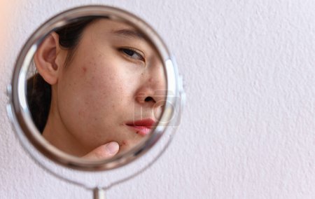 Foto de Recortado tiro de mujer asiática preocuparse por su cara cuando vio el problema del acné y la cicatriz por el mini espejo. Imagen conceptual del acné y la piel problemática en la cara femenina. - Imagen libre de derechos