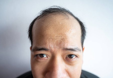 Closed portrait of Asian man with sweating on his forehead cause of hot weather or etc. Sweat is actually the body's built-in cooling system when your body temperature rises.