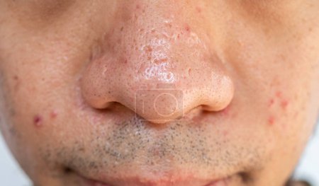 Close up of pores and pimples on men's nose. Nose pores are openings into the skin, where sebaceous glands produce and distribute the skin's natural oil.