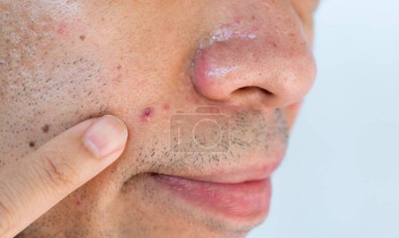 Close up of young man pointing acne occur on his skin. A pimple is a small inflammation or swelling of the skin that may or may not be filled with pus.