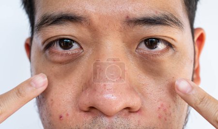 Close up of unhealthy Asian man pointing to his under eyes having dark circles with puffiness problem. Using a collagen hydro gel under-eye mask can allow the skin to be soaked in moisture.