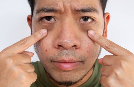 Nahaufnahme eines schlaflosen asiatischen Mannes, der auf seine unter den Augen liegenden Augenringe mit Schwellungen zeigt. Mit einer Collagen-Hydrogel-Unteraugenmaske kann die Haut mit Feuchtigkeit durchnässt werden.