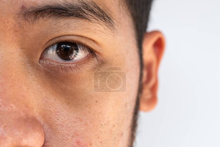 Close up of unhealthy Asian man having under-eye problem such as dark circles and puffiness. Using a collagen hydro gel under-eye mask can allow the skin to be soaked in moisture.