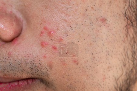 Nahaufnahme von Poren und Pickeln auf der Wange des Mannes. Gesichtsporen sind ein sichtbares topographisches Merkmal von Hautoberflächen.