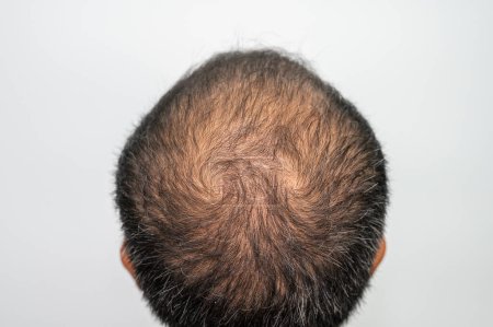 Foto de Vista trasera de la calva de la cabeza de los hombres asiáticos con el pelo delgado y el pelo gris aparecen. Conceptual del problema del cabello en la cabeza de los hombres. - Imagen libre de derechos